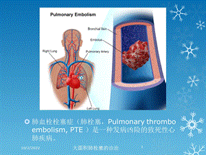 大面积肺栓塞的诊治培训课件.ppt