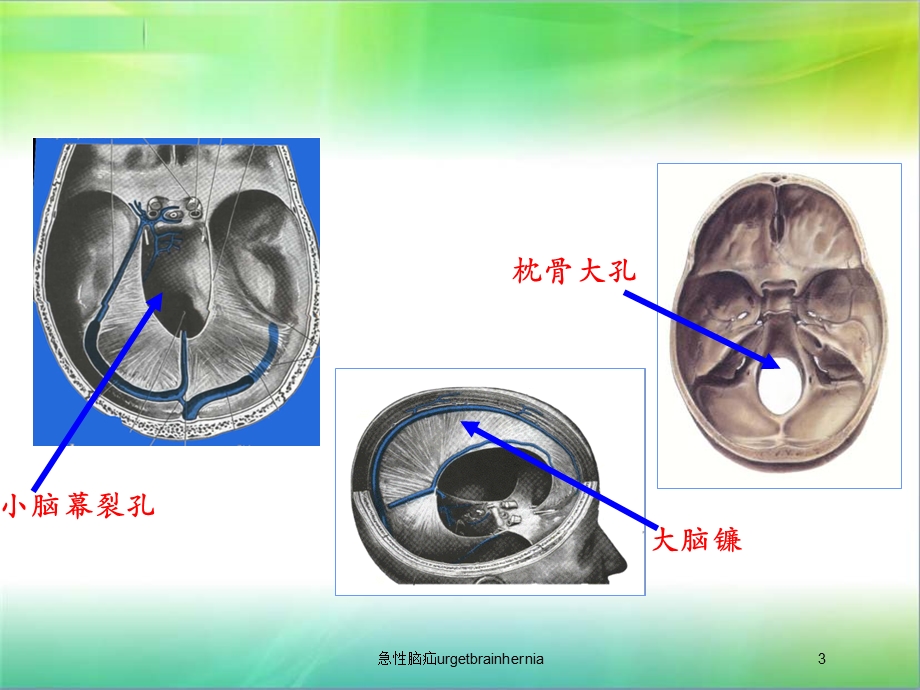 急性脑疝urgetbrainhernia培训课件.ppt_第3页