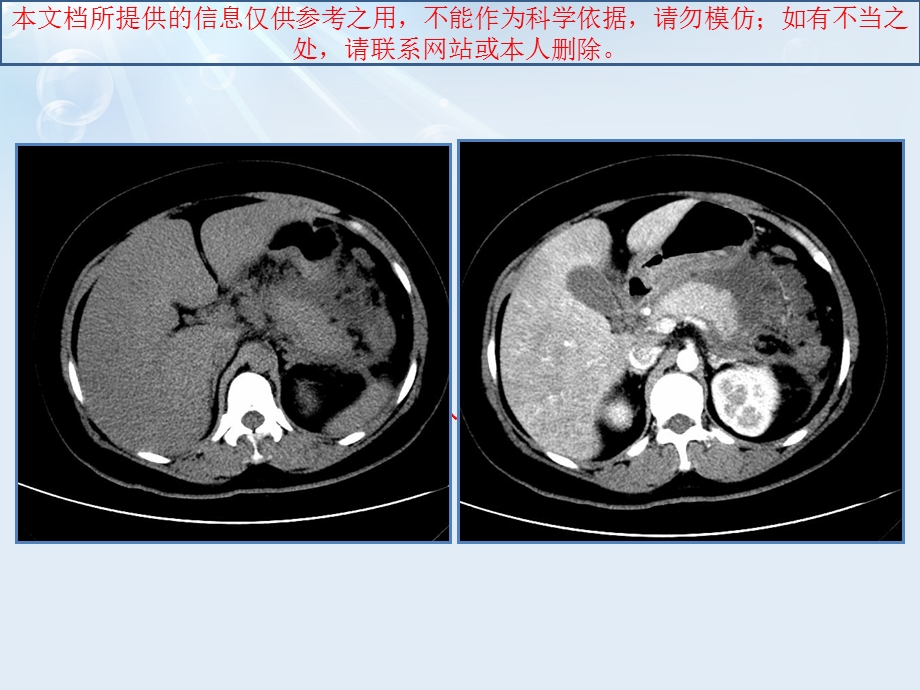 急性胰腺炎液体复苏培训课件.ppt_第1页