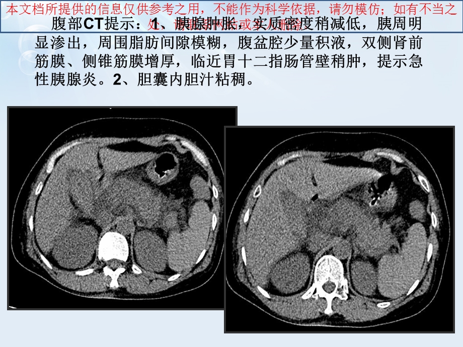 急性胰腺炎液体复苏培训课件.ppt_第3页