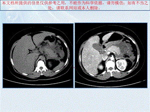 急性胰腺炎液体复苏培训课件.ppt