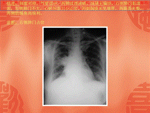 常见四十张X片读片及诊断培训课件.ppt