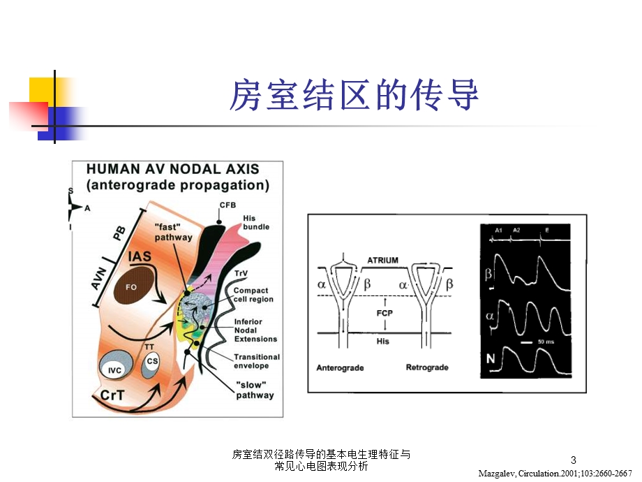 房室结双径路传导的基本电生理特征与常见心电图表现分析培训课件.ppt_第3页