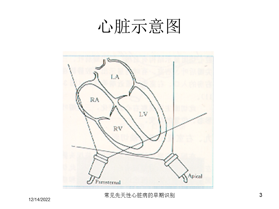 常见先天性心脏病的早期识别课件.ppt_第3页