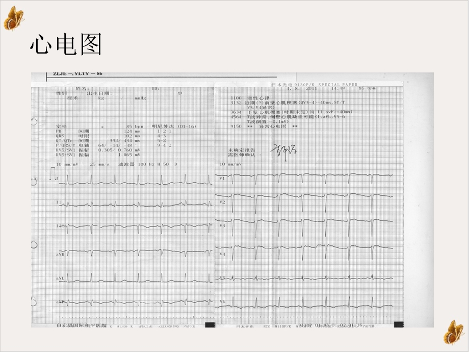 急性心肌梗死合并室间隔穿孔成功救治例课件.ppt_第3页