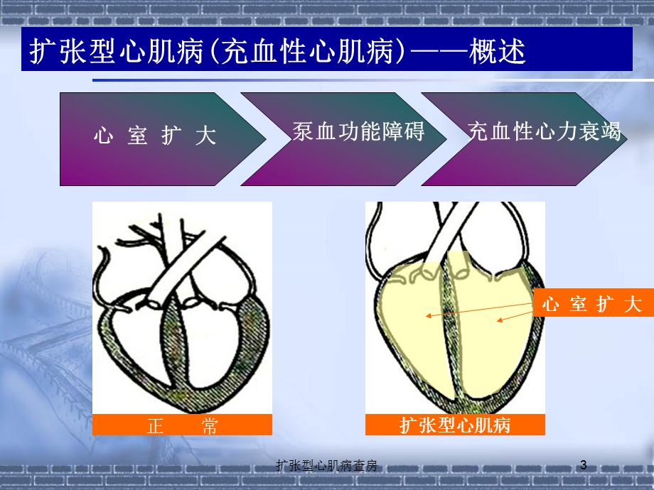 扩张型心肌病查房培训课件.ppt_第3页