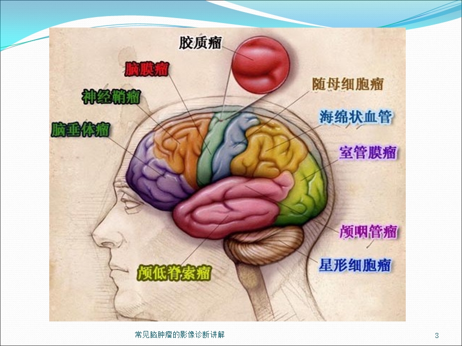 常见脑肿瘤的影像诊断讲解培训课件.ppt_第3页