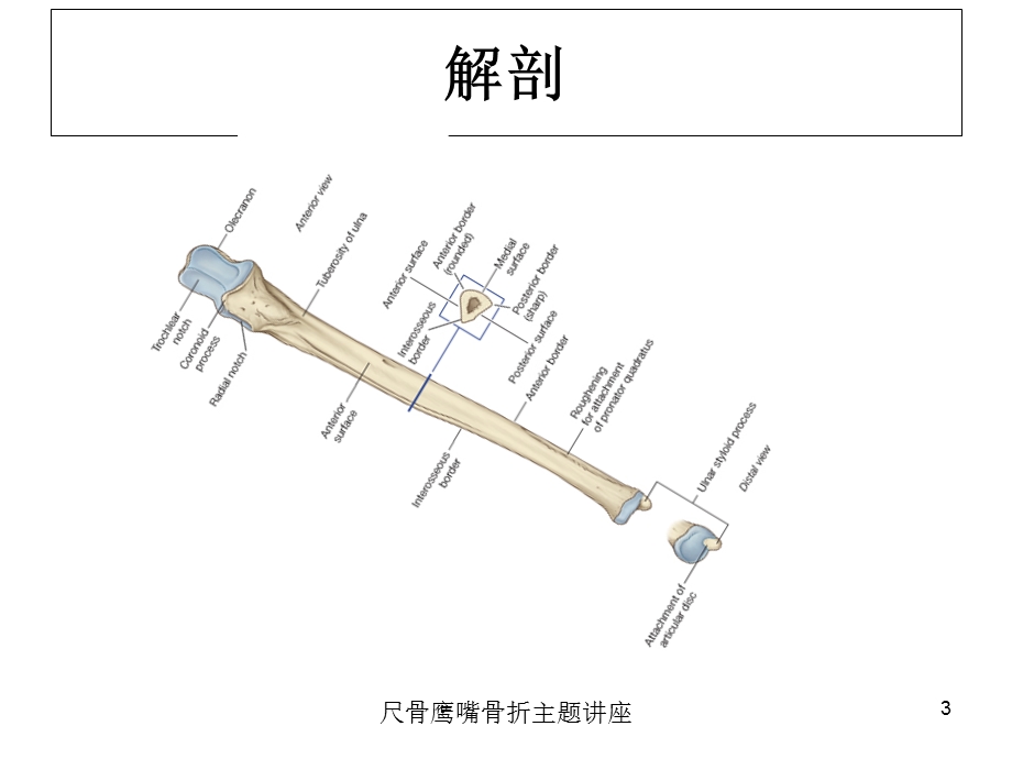 尺骨鹰嘴骨折主题讲座培训课件.ppt_第3页