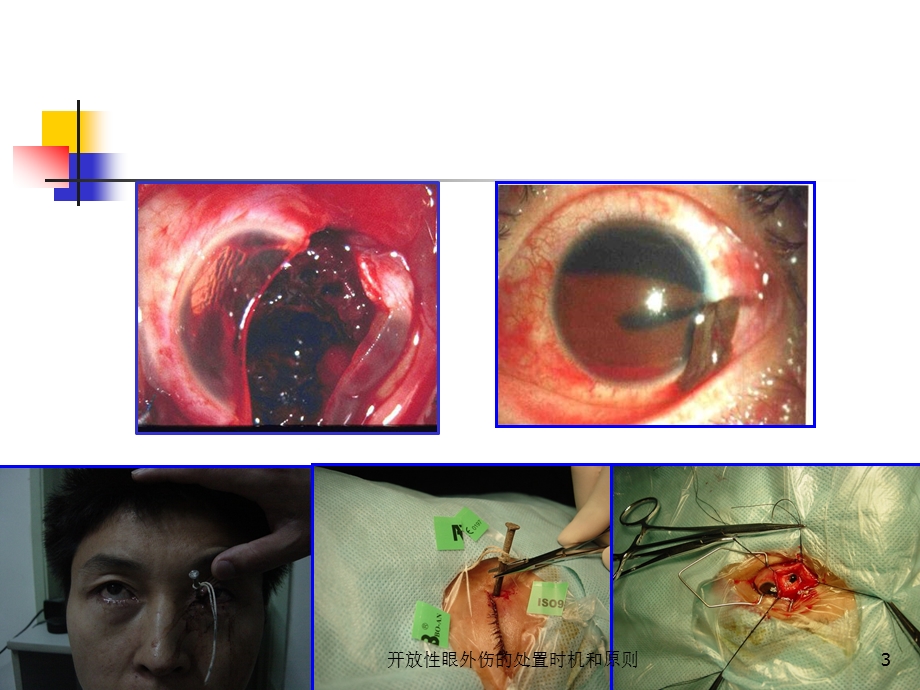 开放性眼外伤的处置时机和原则培训课件.ppt_第3页