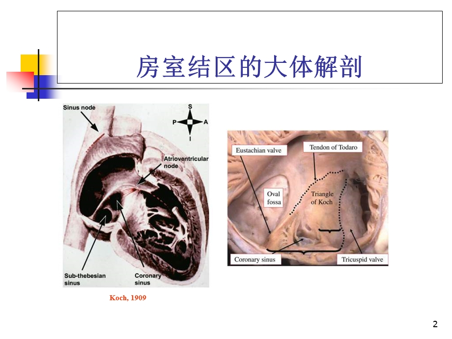 房室结双径路传导的基本电生理特征与常见心电图表现分析优质课件.ppt_第2页