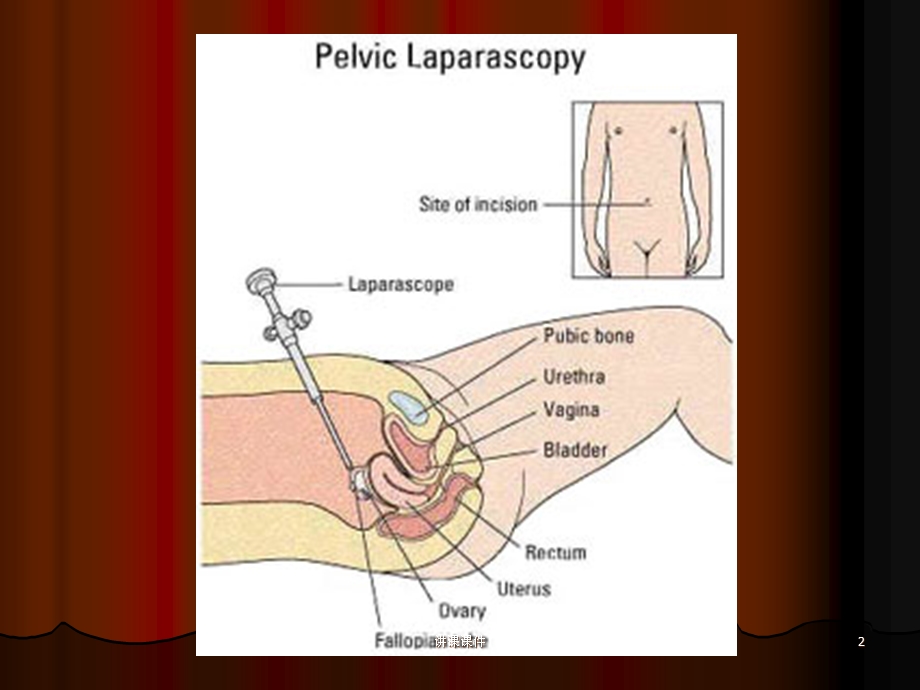 妇科腹腔镜手术的并发症(专业研究)课件.ppt_第2页