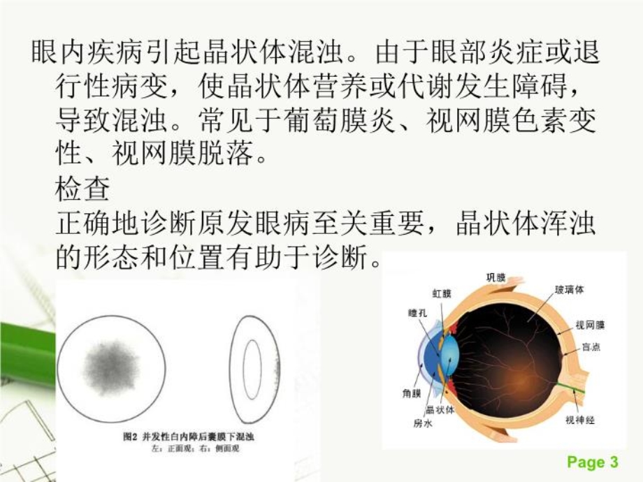 并发性白内障ppt讲义知识课件.ppt_第3页