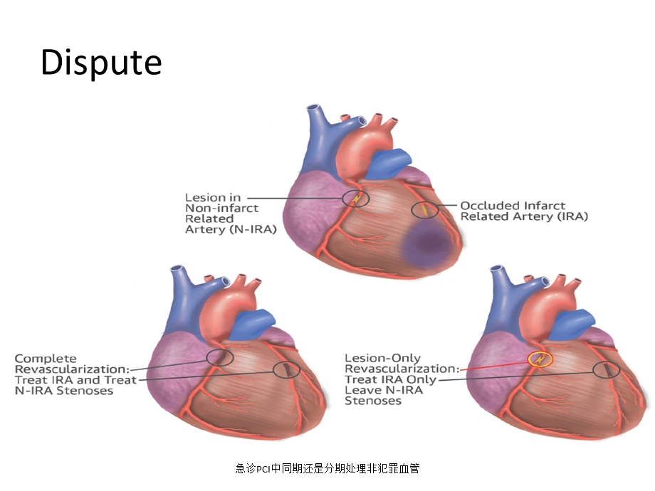 急诊PCI中同期还是分期处理非犯罪血管课件.ppt_第2页