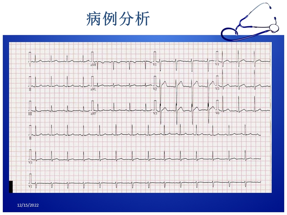 急性胸痛诊治流程课件.ppt_第3页