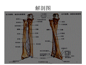 尺桡骨骨折讲解课件.ppt