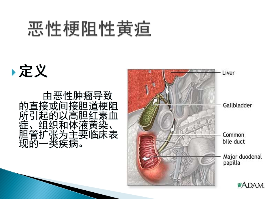 恶性梗阻性黄疸医学课件.ppt_第2页