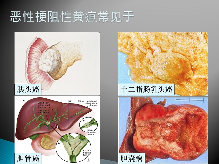 恶性梗阻性黄疸医学课件.ppt_第3页