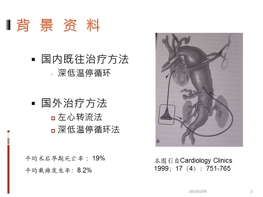 常温胸腹主动脉替换参考课件.ppt_第3页