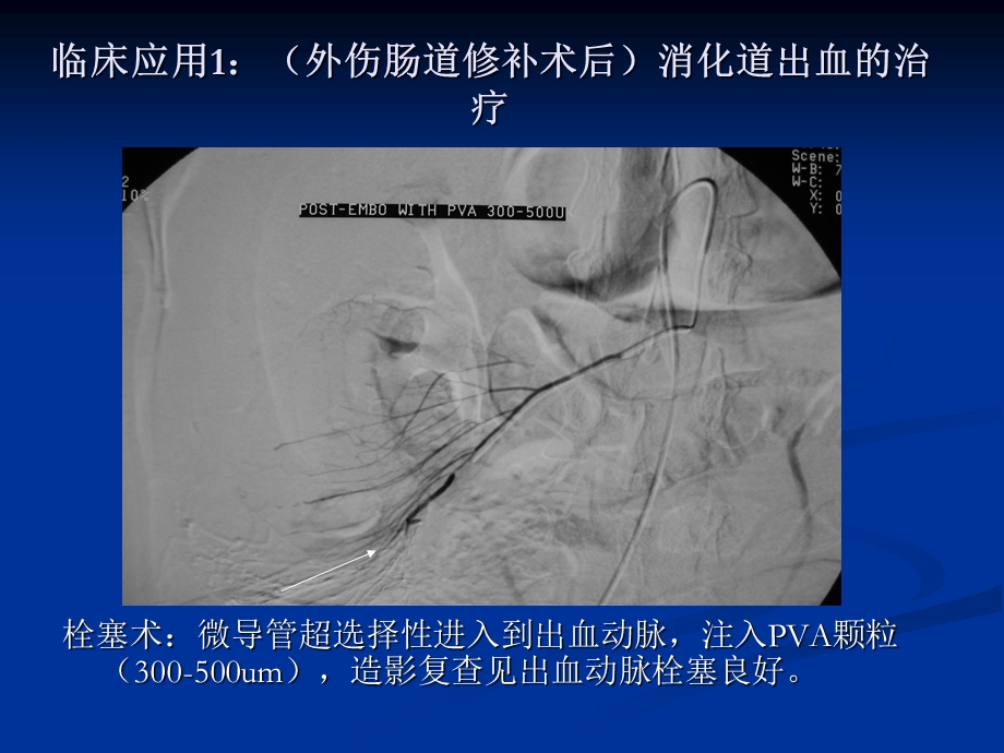 急性动脉性出血的介入治疗课件.ppt_第3页