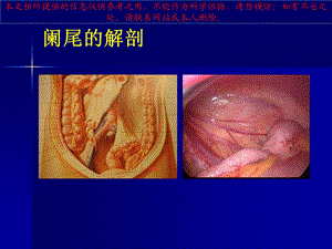 急性阑尾炎教学查房培训课件.ppt