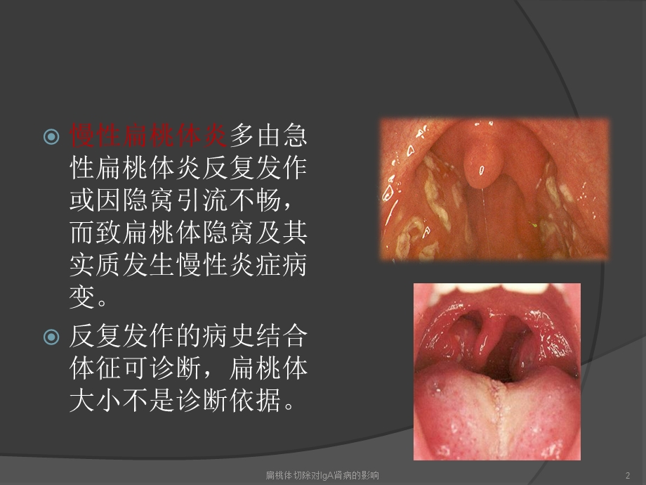 扁桃体切除对IgA肾病的影响培训课件.ppt_第2页