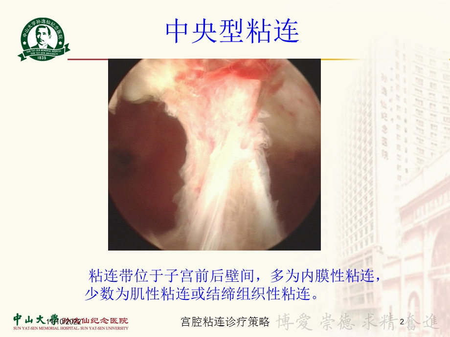 宫腔粘连诊疗策略培训课件.ppt_第2页