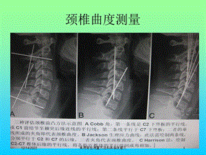 常用脊柱测量方法和其临床意义培训课件.ppt