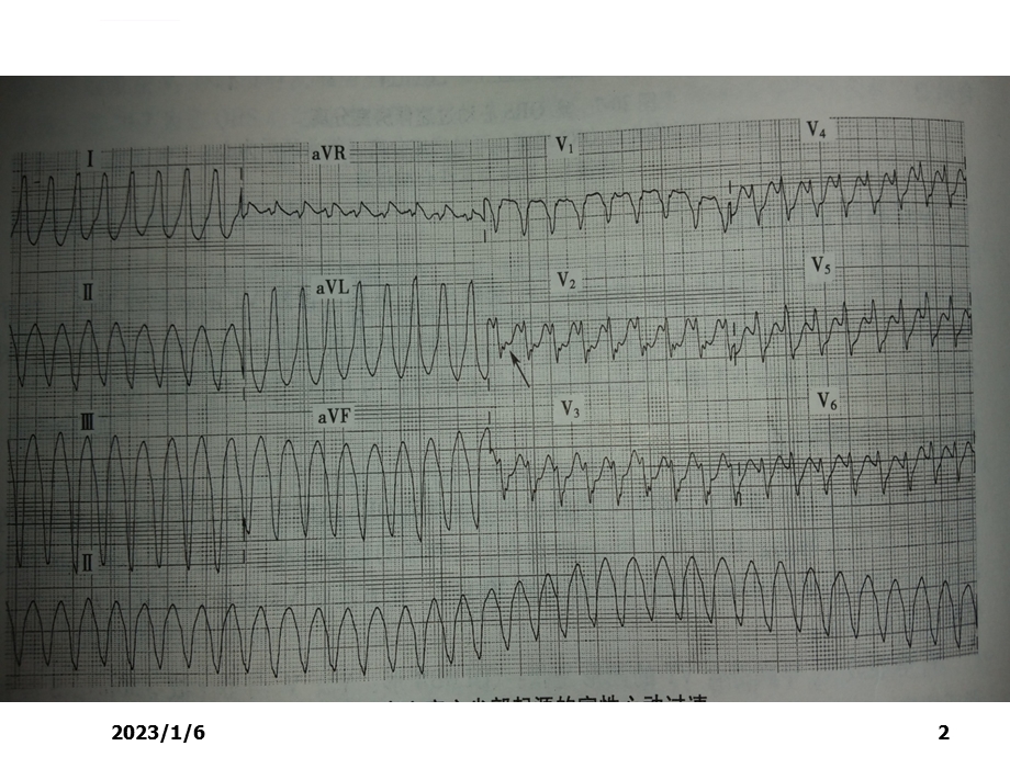 急重症心电图的快速识别及治疗ppt课件.ppt_第2页
