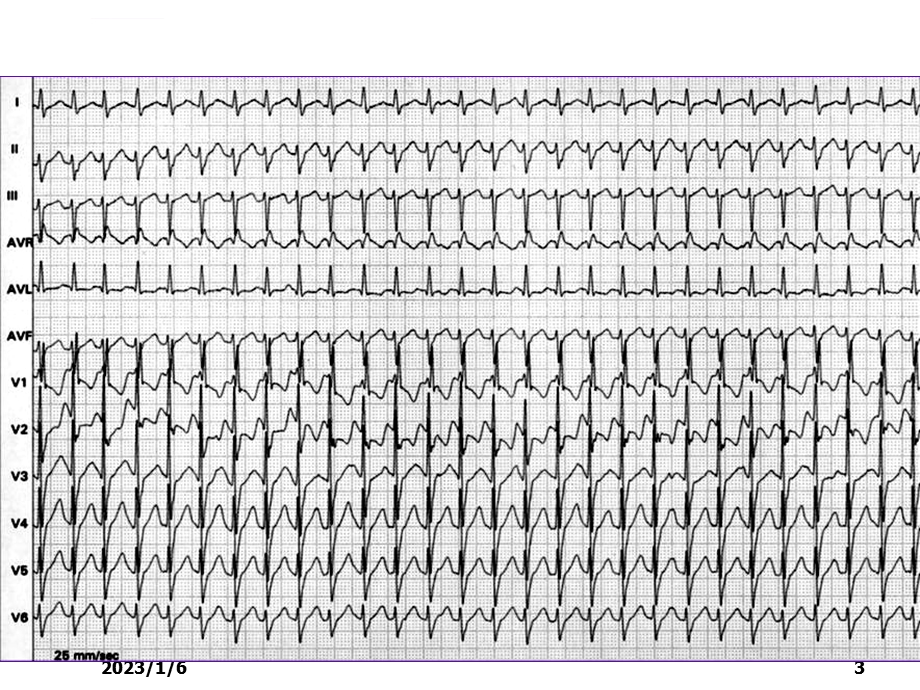 急重症心电图的快速识别及治疗ppt课件.ppt_第3页