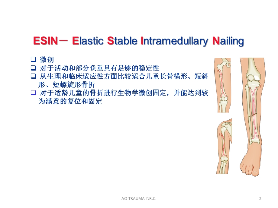 弹性髓内钉治疗儿童长骨骨折课件.ppt_第2页