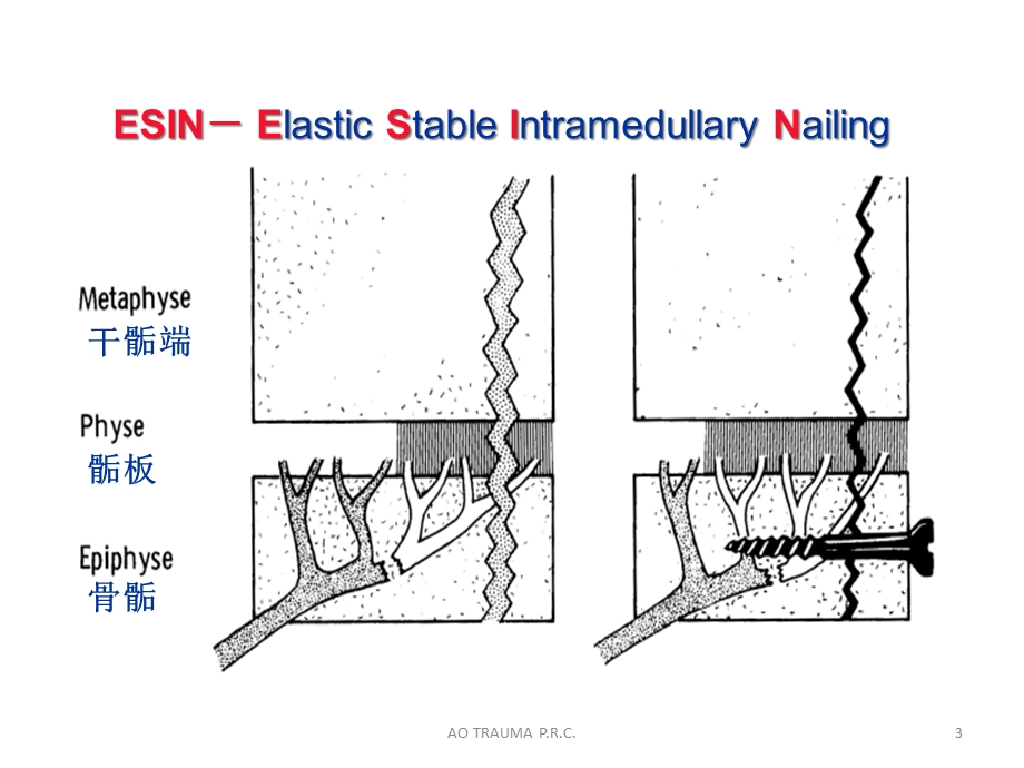 弹性髓内钉治疗儿童长骨骨折课件.ppt_第3页