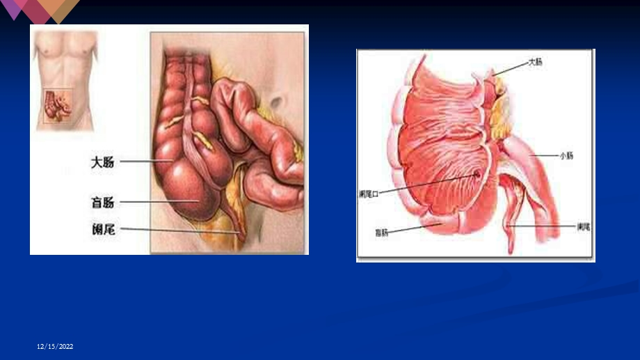 开腹阑尾的护理查房课件.ppt_第3页