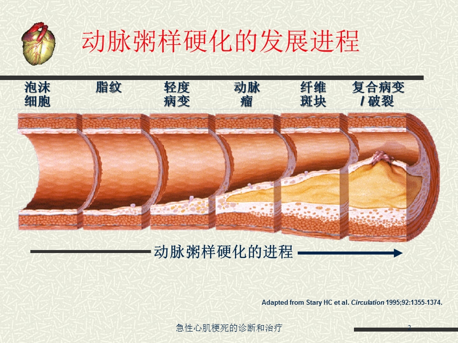 急性心肌梗死的诊断和治疗培训课件.ppt_第2页