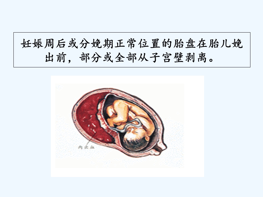 妇产科学——胎盘早剥前置胎盘课件.ppt_第3页