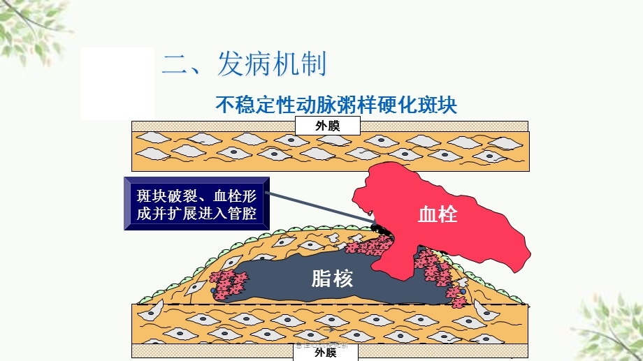 急性心肌梗死新课件.ppt_第3页