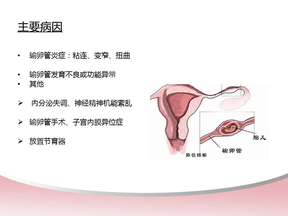 宫外孕腹腔镜术前术后的护理课件.pptx_第3页