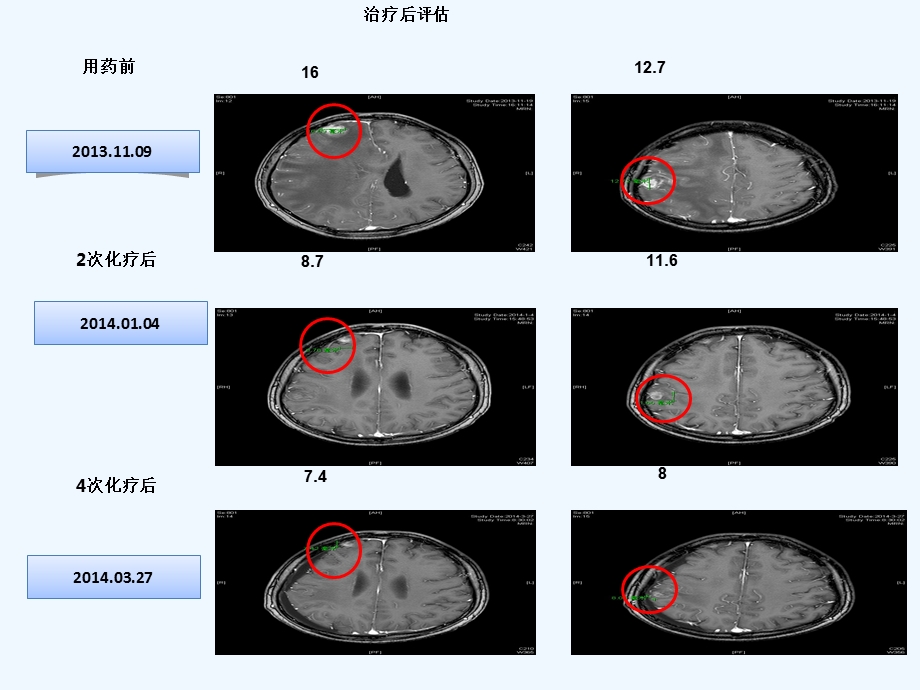 安维汀肺癌脑转移患者分子靶向治疗疗效和安全性课件.ppt_第3页