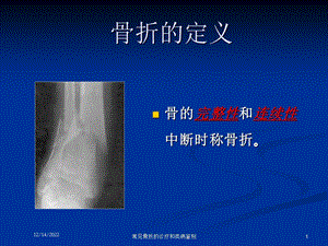 常见骨折的诊疗和类病鉴别课件.ppt