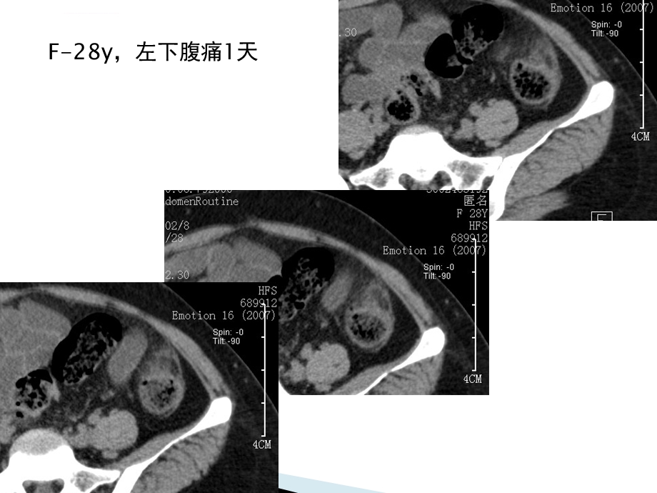 急性肠脂垂炎的CT诊断ppt课件.ppt_第1页