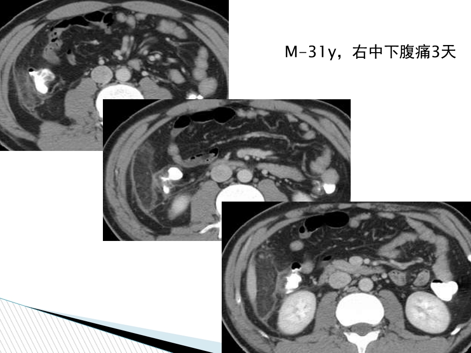 急性肠脂垂炎的CT诊断ppt课件.ppt_第2页