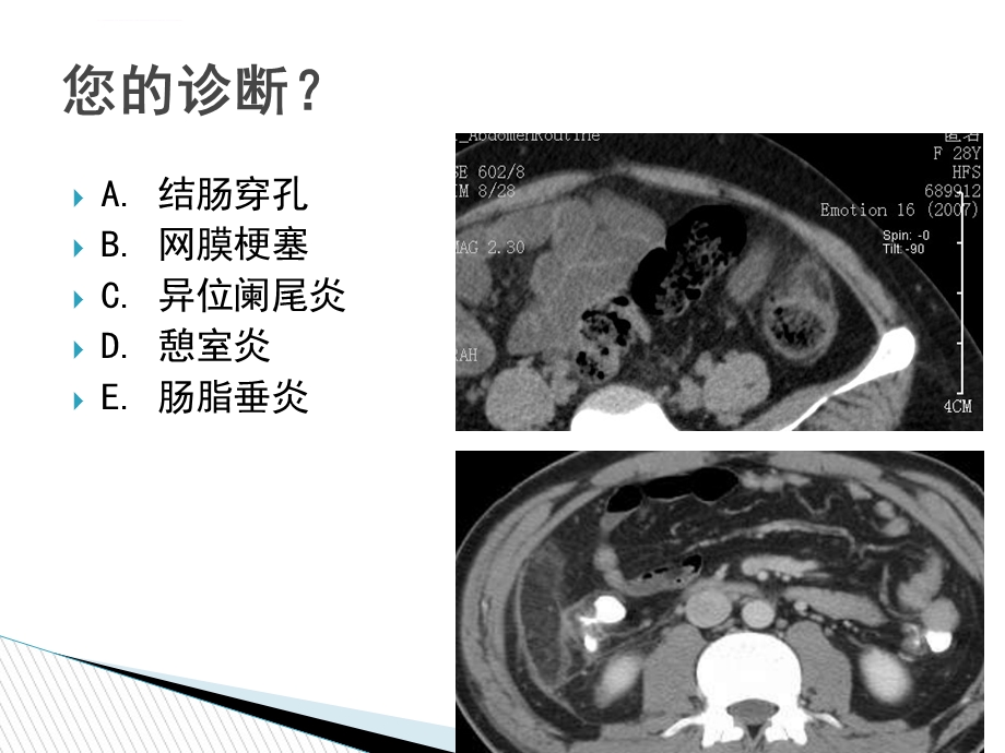 急性肠脂垂炎的CT诊断ppt课件.ppt_第3页