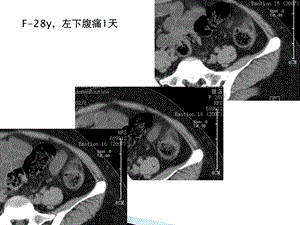 急性肠脂垂炎的CT诊断ppt课件.ppt