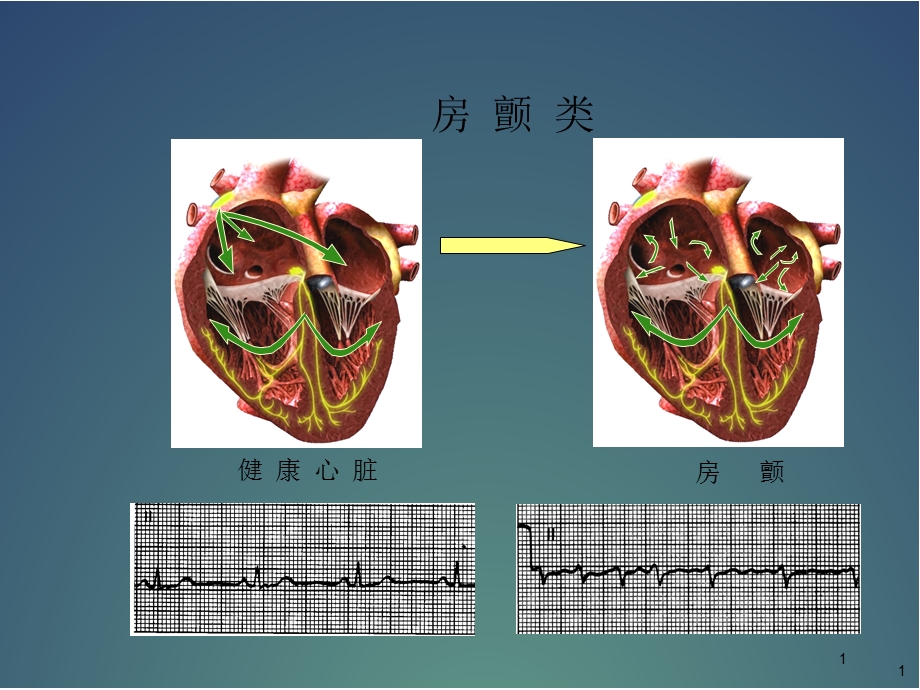 房扑与房颤心电图医学课件.ppt_第1页