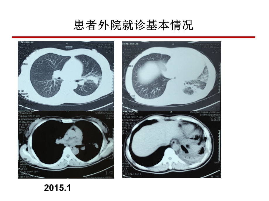 恩度联合放化疗治疗晚期非小细胞肺癌病例分享.pptx_第3页