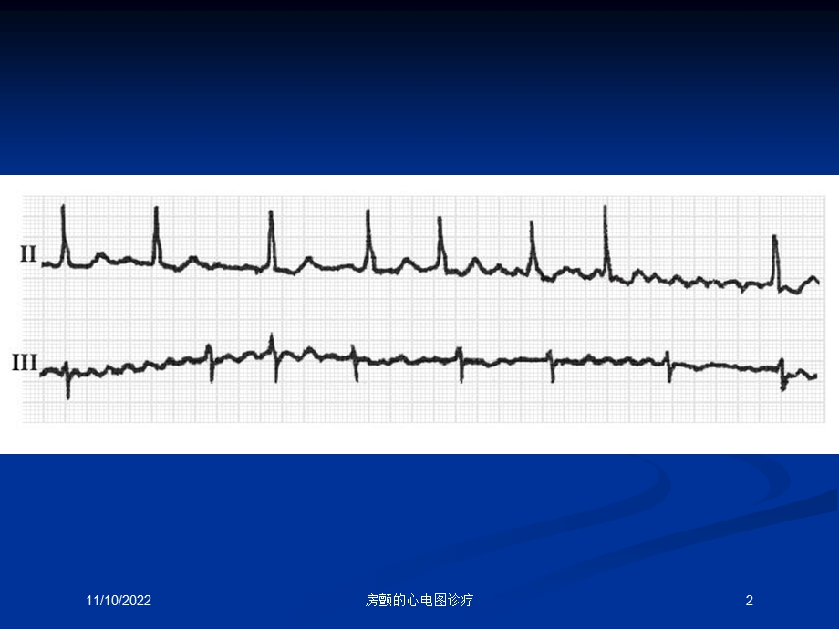 房颤的心电图诊疗培训课件.ppt_第2页