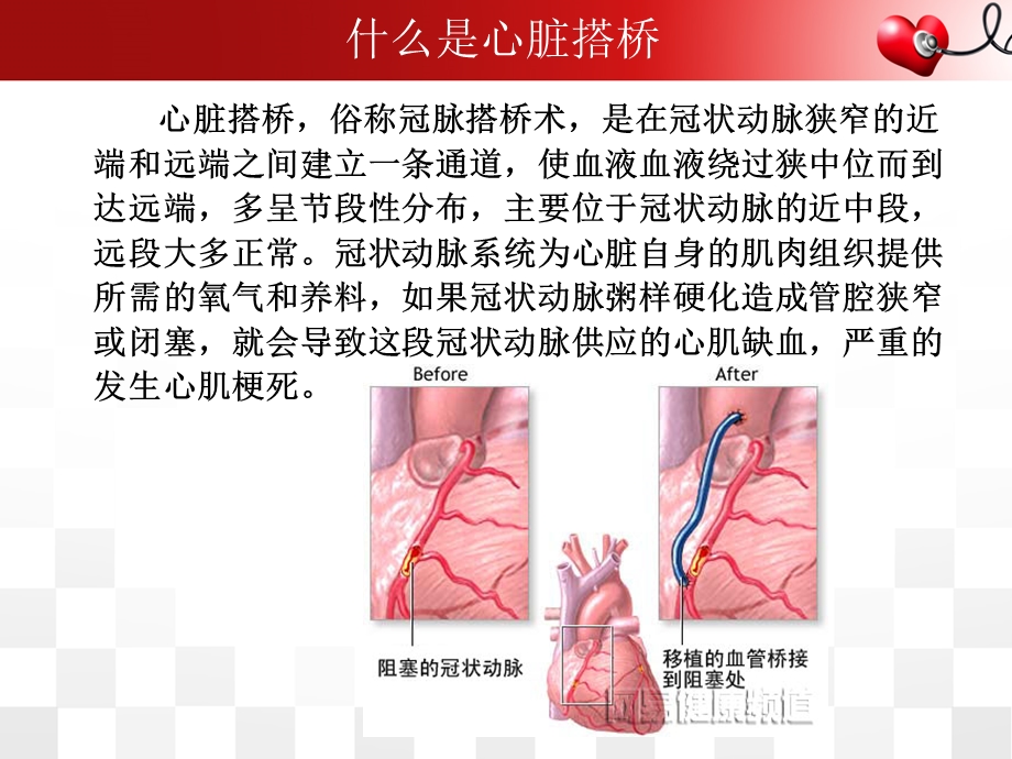 搭桥术后护理查房课件.ppt_第2页