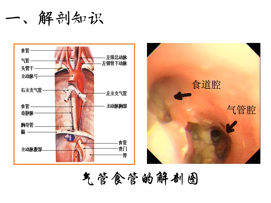 气管食管瘘版课件.pptx_第2页