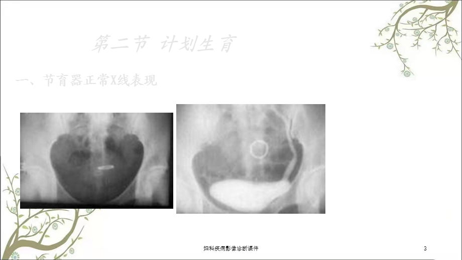 妇科疾病影像诊断课件.ppt_第3页