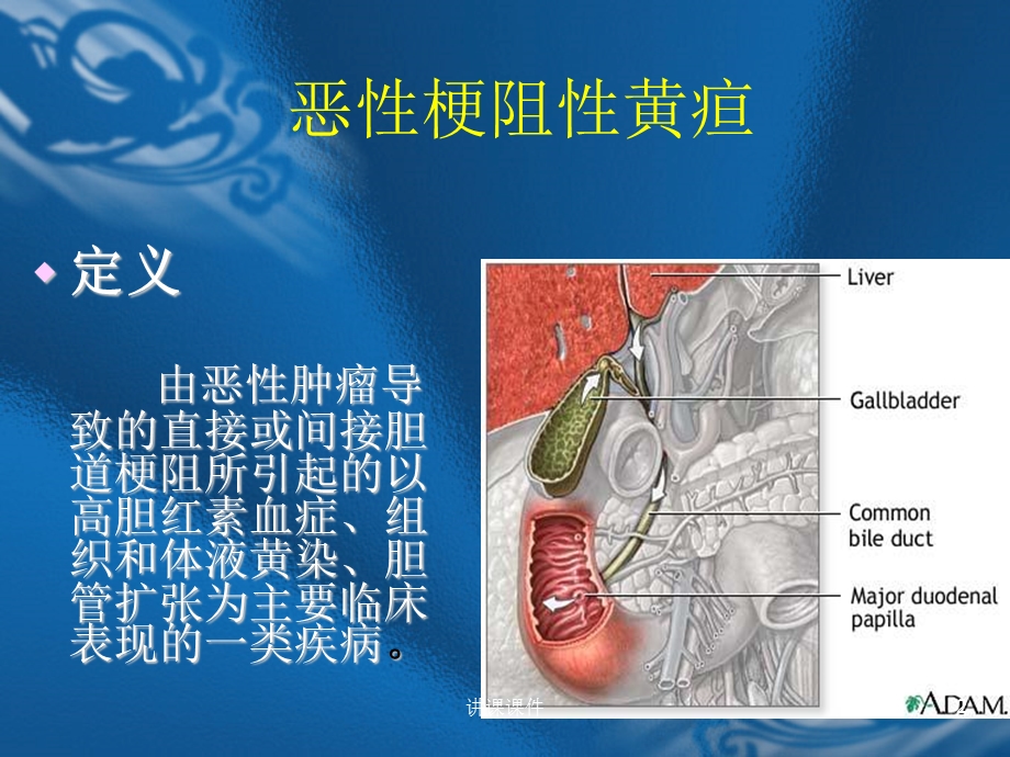 恶性梗阻性黄疸(行业特制)课件.ppt_第2页