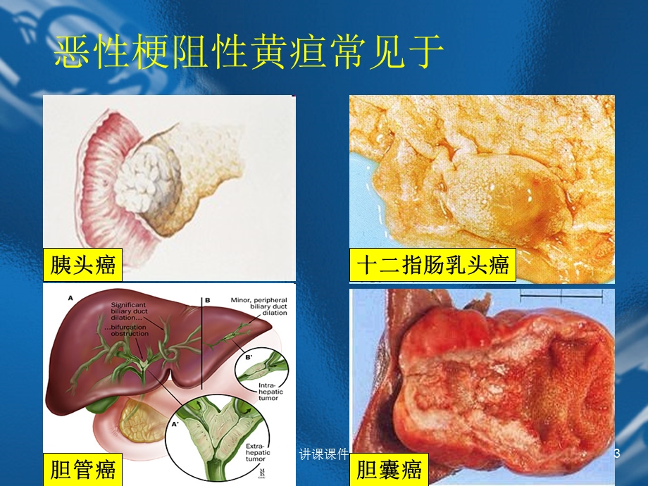 恶性梗阻性黄疸(行业特制)课件.ppt_第3页